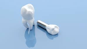 Research institutes sometimes conduct clinical trials involving teeth implants and other dental procedures. Can Drug Loaded Dental Implants Offer Pain Free Chronic Med Delivery