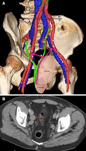 In stage 2, the tumor is still confined to your prostate and hasn't spread to lymph nodes or other parts of your body. Figure 13 Pelvic Lymph Nodes And Pathways Of Disease Spread In Male Pelvic Malignancies Springerlink