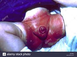 Image result for newborn diaper rash