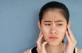 Image result for acne face