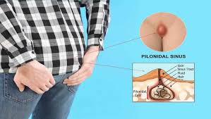 Image result for Pilonidal Cyst