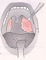 Die behandlung einer tonsillitis acuta, sei diese eitrig oder nicht, sollte wegen der gefahr von folgeerkrankungen niemals auf die leichte schulter genommen werden. Mandeloperationen Mandelentzundung Kantonsspital Baselland
