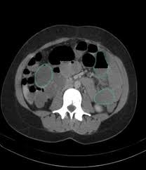 Image result for Adynamic Ileus