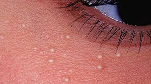 White Spots On Face What S Causing It White Skin Spots Unwanted Hair Removal Spots On Face