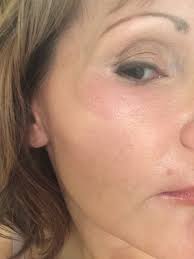 But these products may contain chemical ingredients that can cause an allergic reaction (like contact dermatitis). How Long After An Artefil Injection Can An Allergic Reaction Present Photos