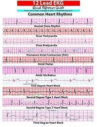 Ekg Pocket Card 9781941004067 Amazon Com Books