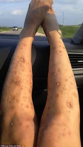 They contain both of cooling and refreshing properties that make them one of the best home remedies. Woman Who Compulsively Picked Skin Bares Her Legs Daily Mail Online