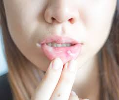 Image result for Puchýře na jazyku