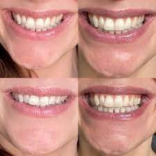 Do you want to get good oral health? Spotlight Teeth Whitening System Amy S Chapter