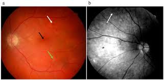 These conditions should not be confused with diabetes insipidus which is clinically distinct and not related to hype. Ijms Free Full Text Compromised Barrier Function In Human Induced Pluripotent Stem Cell Derived Retinal Pigment Epithelial Cells From Type 2 Diabetic Patients Html