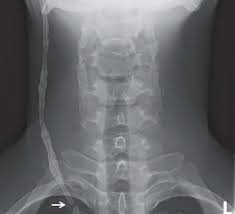 Ventriculoperitoneal Shunt Malfunction Radiology Key
