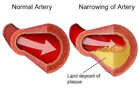 Healthy cholesterol level — Stroke Recovery