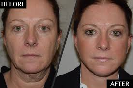 How a Split-Second Decision Restored This Woman's Youthful Face