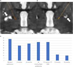 Image result for Pallidotomy