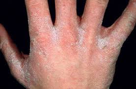 Image result for scabies norvegica