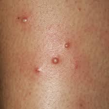 Cleaning it can get rid of bacteria causing the skin infection. Folliculitis Hot Tub Rash In Children Babycenter