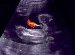 10 Anzeichen Die Angeblich Babys Geschlecht Verraten