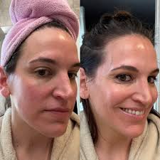 I'm supposed to be signing my contract for the Tshape 2 tomorrow for body  contouring, but would like more real feedback before committing to a 90k  piece of equipment. Any feedback would