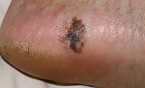 Image result for brown patches on the feet