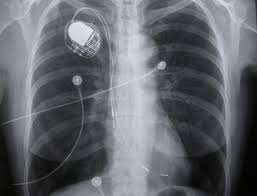 Pacemaker and icd manufacturers are arranged in alphabetical order with devices organized in numeric sequence. Early Complications After Pacemaker Implantations Intechopen