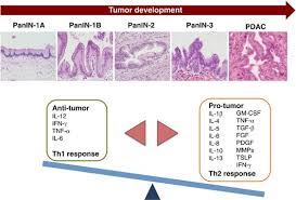 How much the tumour in the pancreas has grown and whether it has grown partially or fully through the wall of the pancreas. The Immune Network In Pancreatic Cancer Development And Progression Oncogene