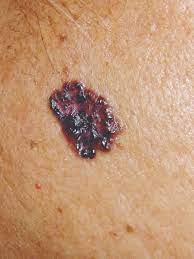 When malignant cancer cells form and grow within a person's breast tissue, breast cancer occurs. Ask The Expert Is There A Skin Cancer Crisis In People Of Color The Skin Cancer Foundation