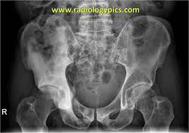Bones are the most common site of hematogenous metastases of prostate cancer. Solution To Unknown Case 32 Prostate Metastases To Bone Radiologypics Com