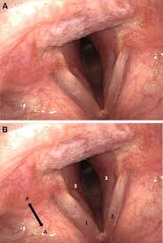 Image result for Acute Laryngitis