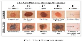 E is for evolving the spot looks different from the rest or is changing in size, shape, or color. Figure 3 From Identification Of Melanoma In Dermoscopy Images Using Image Processing Algorithms Semantic Scholar