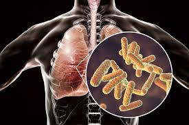 Terdiri dari dokter, ahli gizi, respiratori terapis dan psikolog.program rehabilitiasi terdiri dari 3 komponen yaitu : 3 Penyebab Pneumonia Radang Paru Paru Yang Perlu Anda Tahu