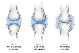 Wie hoch ist ihr arthrosestadium? Arthrose Causes Symptomes Et Traitements De L Arthrose Orliman