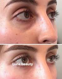 فيلر تحت العين الإيطالي أو البلجيكي المميز ... للحجز والاستعلام 0932720279