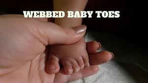 Webbed toes is the common name for syndactyly affecting the feet. 1 23 2017 My Niece Has Webbed Toes Youtube
