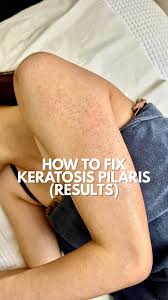 Image result for Keratosis pilaris