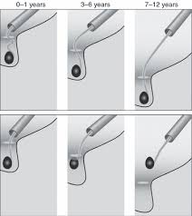 Image result for Undescended Testicle