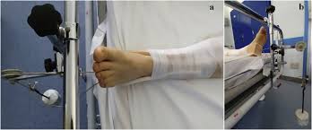 Being immobile and elderly leads. Clinical Practice And Nursing Management Of Pre Operative Skin Or Skeletal Traction For Hip Fractures In Elderly Patients A Cross Sectional Three Institution Study Sciencedirect
