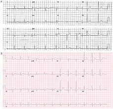 This is known as an escape rhythm. A The Patient S 12 Lead Ecg With Third Degree Atrioventricular Av Download Scientific Diagram
