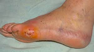 Image result for diabetic toes