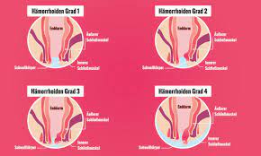 Hämorrhoiden sind nicht immer krankhaft ursachen: Was Sind Hamorrhoiden Alle Infos Auf Praxisvita De