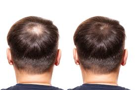 Instead, the cosmetic surgeon makes micro punctures to extract individual hair follicles to transplant them into the recipient site. Fue Hair Transplants Methods Drt Hair Best Hair Transplant Clinic