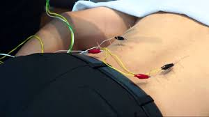 Acupuncture Physiopedia