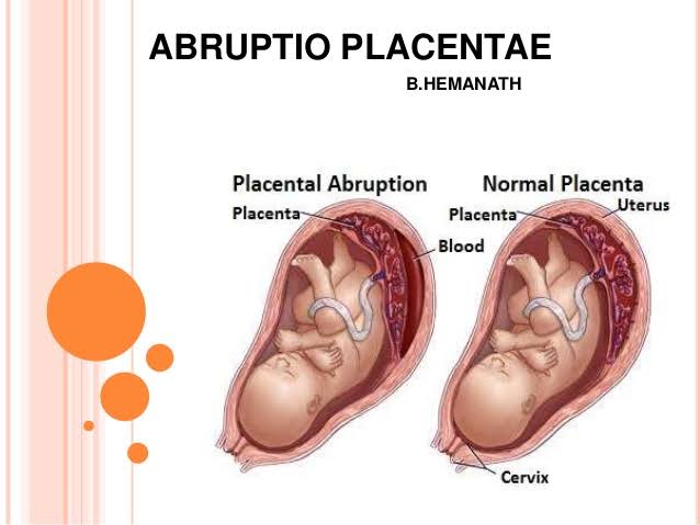 Mga resulta ng larawan para sa Placenta abruptio (animation)"