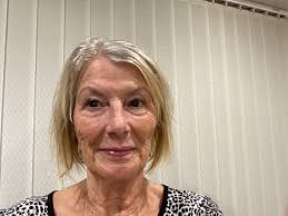 Bethany, 52, is 7 days after her Omakase Facelift®️She has a disarming,  gentle sweetness about her. Her surgery included:✓ Deep plane extended  facelift✓ Deep necklift (#neckbynayak)✓ Minimal incision browlift ✓ Upper  blepharoplasty