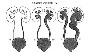 Classification Of Grades Of Vesicoureteral Reflux Adopted By The International Reflux Study Committee