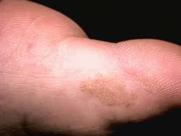 Image result for brown patches on the feet