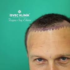 Isvec Klinik Isvec Teknigi Ile Trassiz Sac Ekimi Garantili Sac