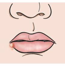 Cold sores are an extremely common condition, which many people experience during their lives. When Your Child Has Cold Sores Saint Luke S Health System