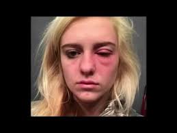 Before bleaching your hair, you should pay a visit to your dermatologist and ask to do a patch test to see how your skin reacts to bleach. Allergic Reaction To Hair Dye Youtube