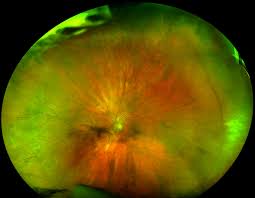 And with the optos, we can rotate, magnify and examine any part of the eye in search of systemic conditions or impending vision problems. Retinal Holes And Tears Recognizing Pathology Optos