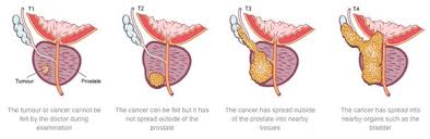 Sometimes, in people who have not had screening, it may be. Prostate Cancer Treatment Symptoms Causes Diagnosis